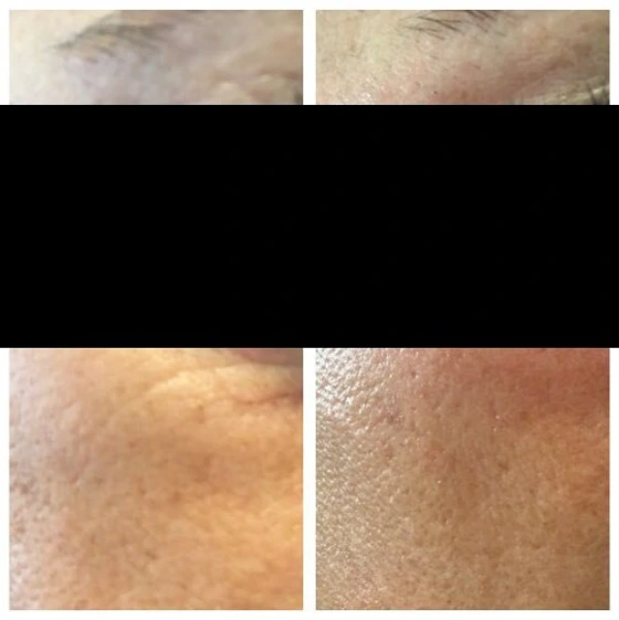 Prima / dopo 1 trattamento con Bio RIGENERA® O3 Anti-Age.