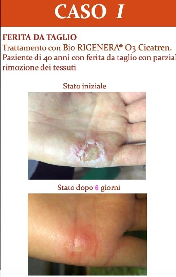 Ferita da taglio, paziente di 40 anni: stato iniziale / guarigione a 6 giorni con Bio RIGENERA® O3 Cicatren.