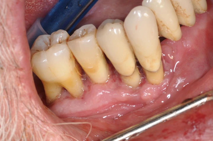 Guarigione del decubito a 24 ore con trattamento Bio RIGENERA® O3 Dental