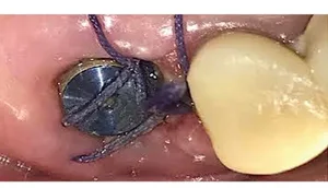 Guarigione peri-implantare