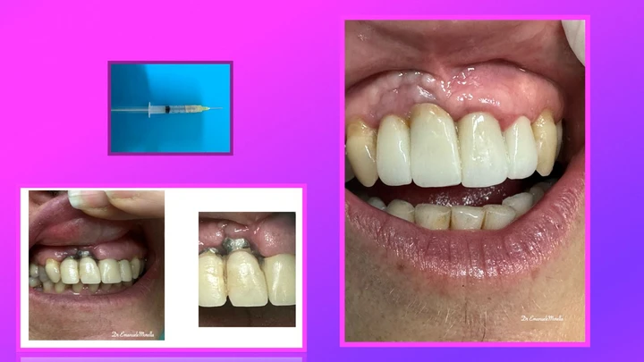 Grave recessione sanguinante — guarigione a 30 giorni con trattamento Bio RIGENERA® O3 Dental