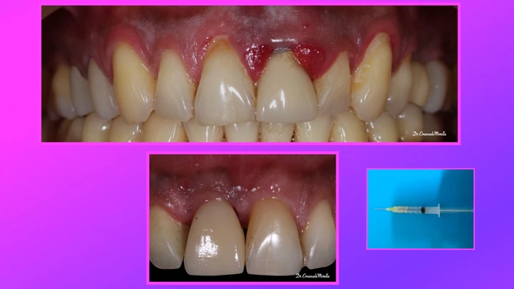Guarigione a 24 ore — rigenerazione dei tessuti dopo 30 giorni con Bio RIGENERA® O3 Dental