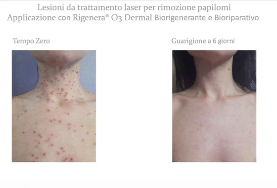 Lesioni da trattamento laser per rimozione papillomi, applicazione con Bio RIGENERA® O3 Dermal - tempo zero / guarigione a 6 giorni.