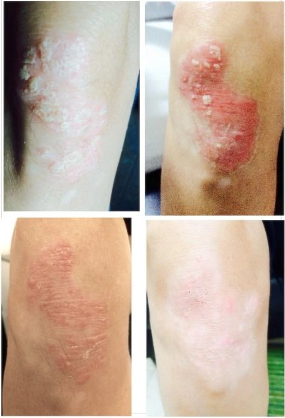 Trattamento per la psoriasi a 20 giorni.