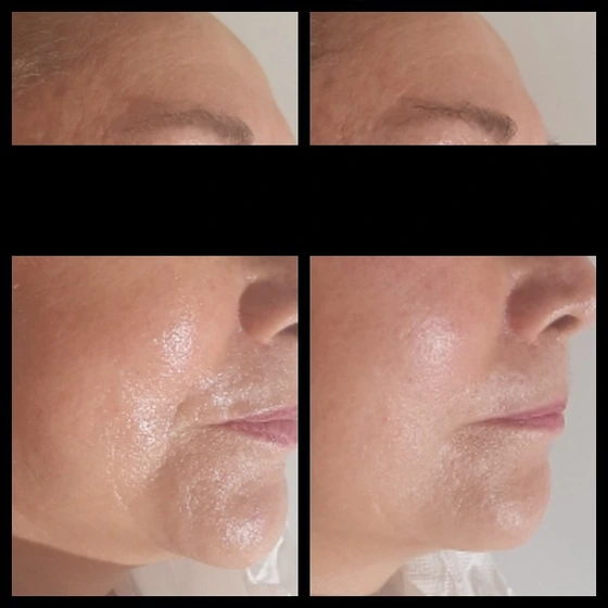 Donna, 70 anni - prima / dopo il 1° trattamento. Risultato ottenuto in abbinamento a trattamenti medico-estetici (radiofrequenza e coolifting).